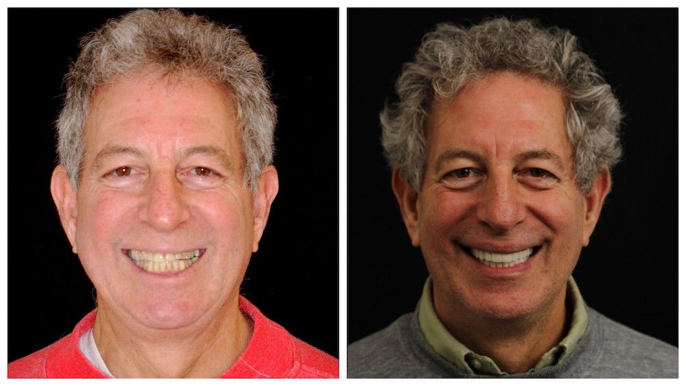 before--after-03-dedicated-dental