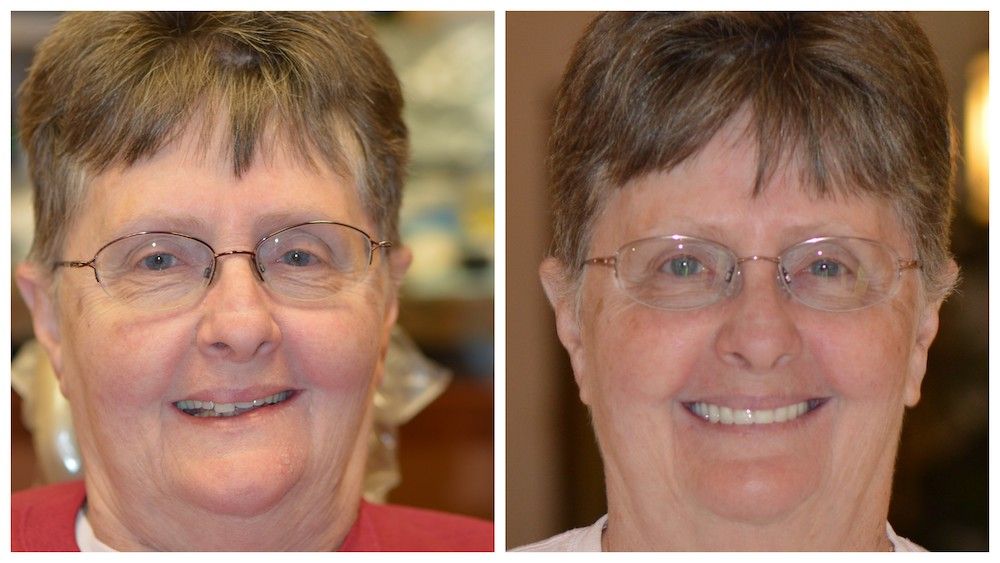 before--after-04-dedicated-dental