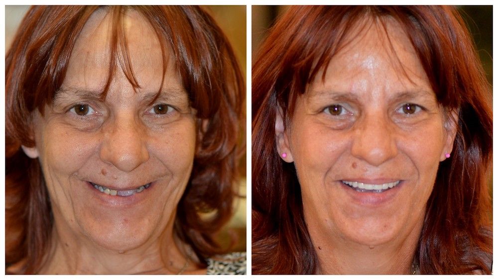 before--after-06-dedicated-dental