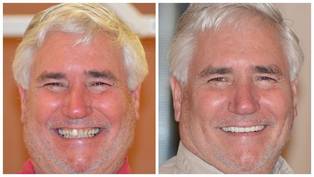 before--after-08-dedicated-dental